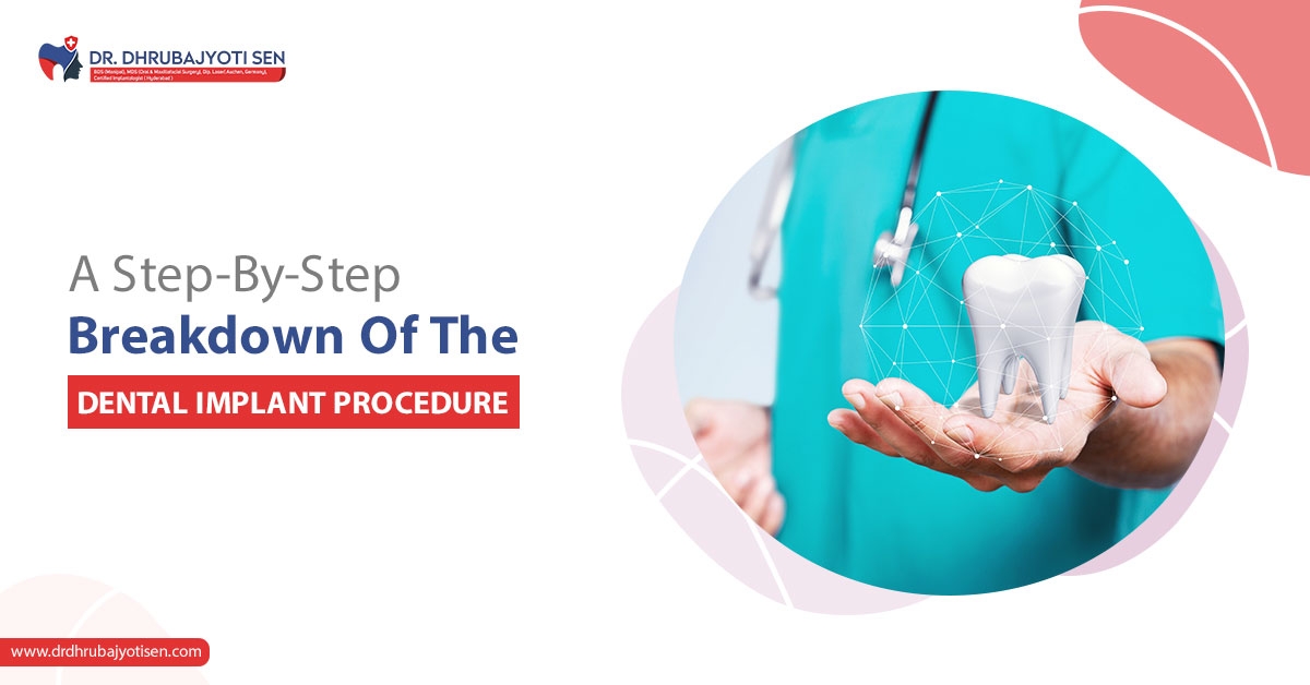 dental implant in Siliguri